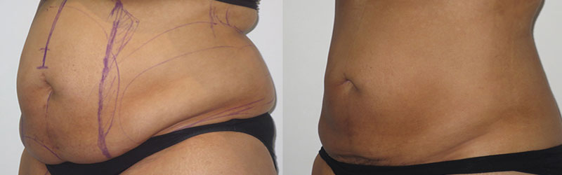 Mega Liposuction Before and After