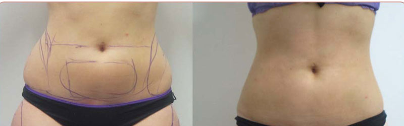 Mega Liposuction Before and After