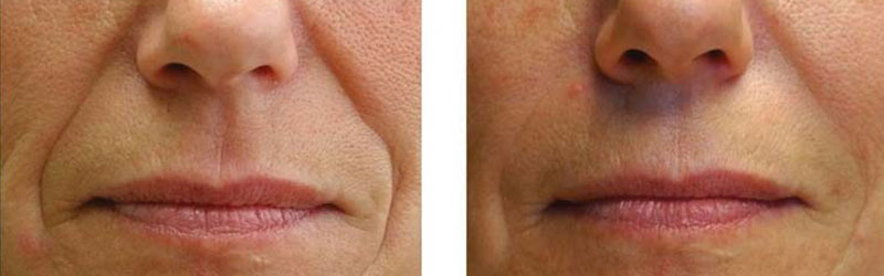 non surgical facelift