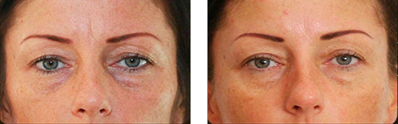 non surgical facelift