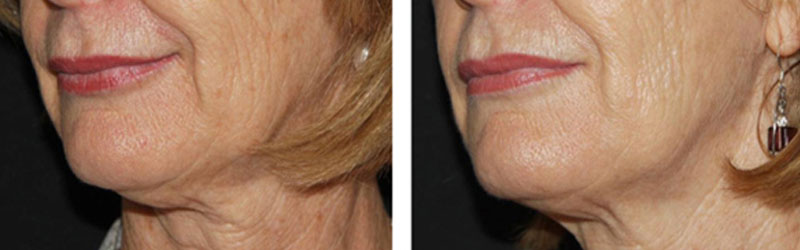 vampire facelift