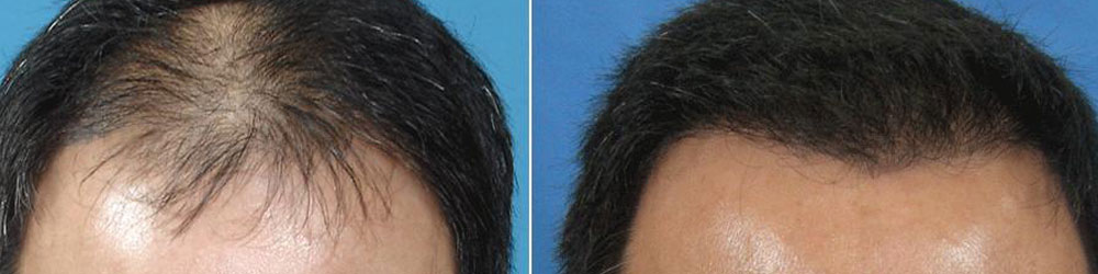 hair transplant