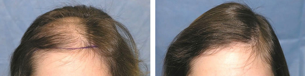 hair transplant