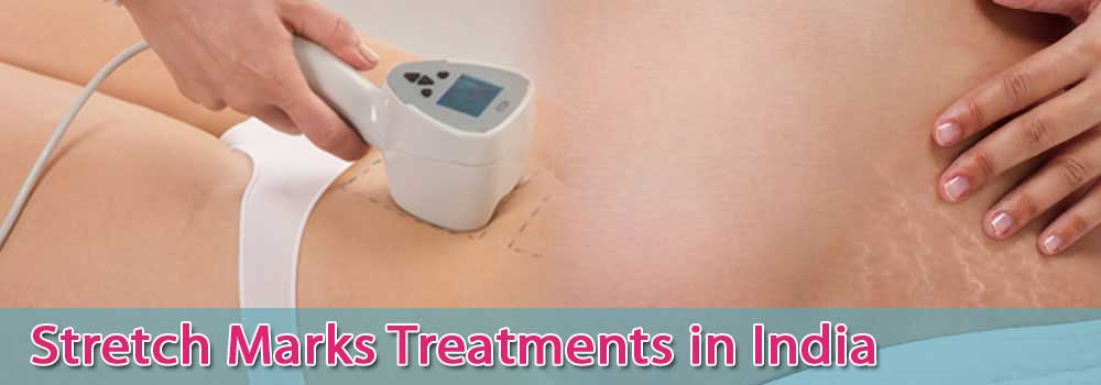stretch marks treatments in india